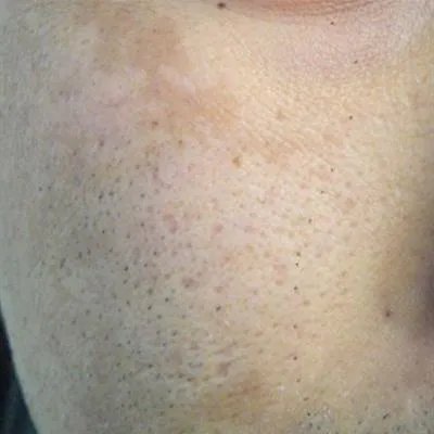 脸上的黄褐斑怎么去掉