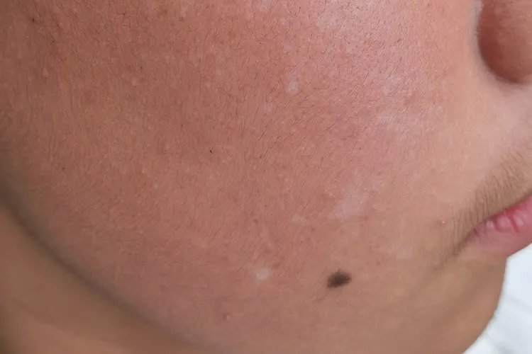 淡白色白斑图片大全