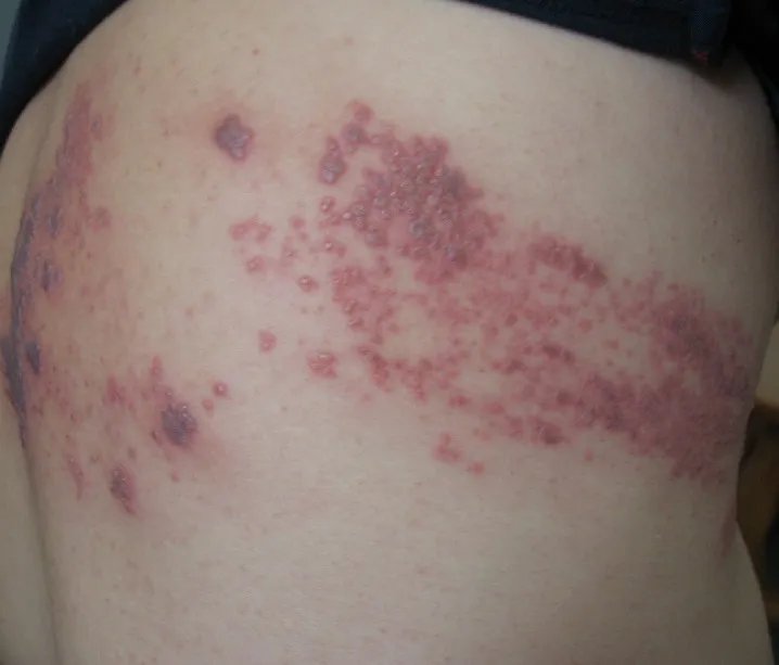 蛇盘疮初期图片