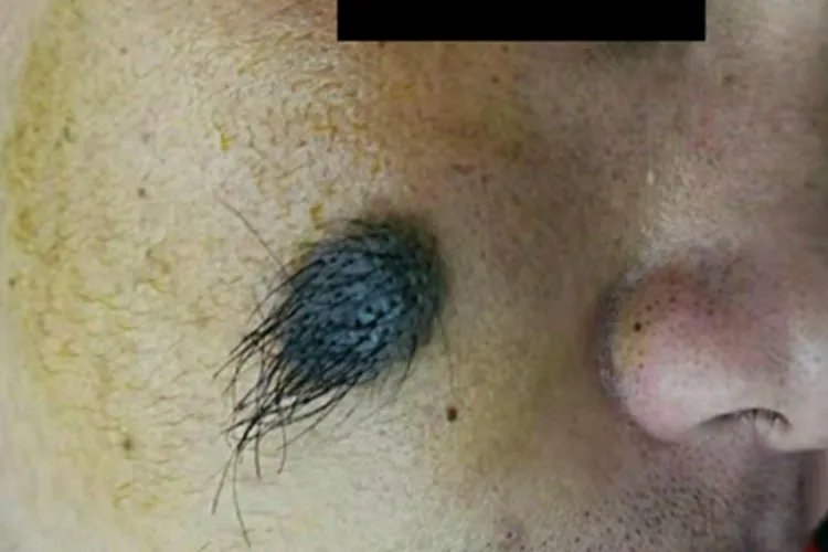 复合痣黑痣图片