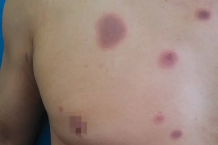 红斑型药疹图片