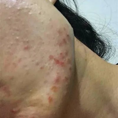  脸颊长痘是怎么回事