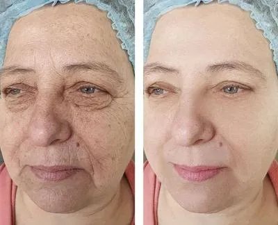 自体脂肪面部填充能维持多久