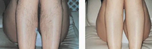 冰点无痛脱毛价格