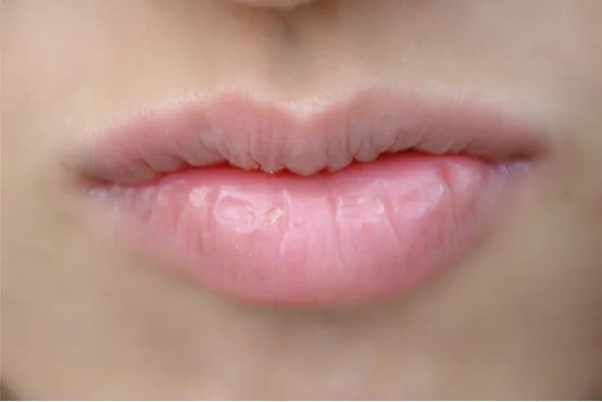 过敏性唇炎是什么