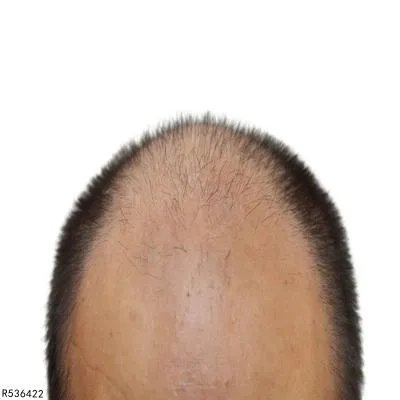 斑秃治好需要多少费用 治疗斑秃花费费用具体介绍