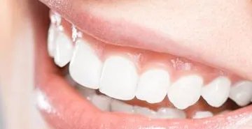 种植牙后的注意事项