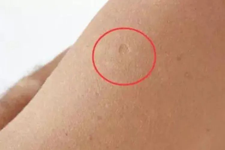 卡介苗和牛痘疤痕区别图片