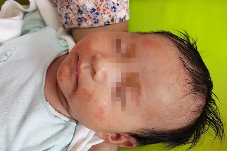 孩子身上起红疙瘩很痒图片