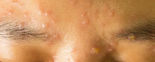 太阳穴长痘痘是什么原因