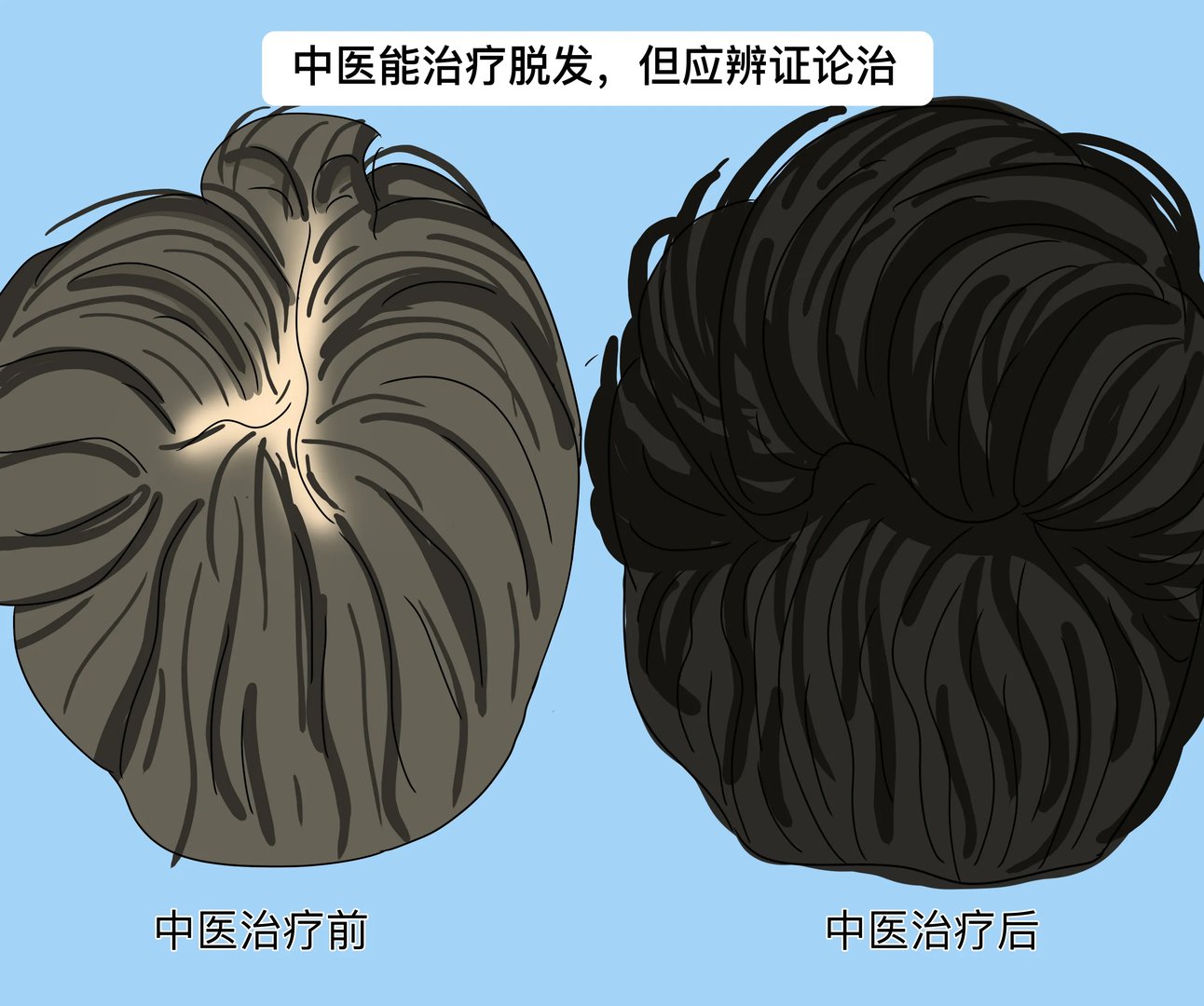 中医能治疗脱发吗