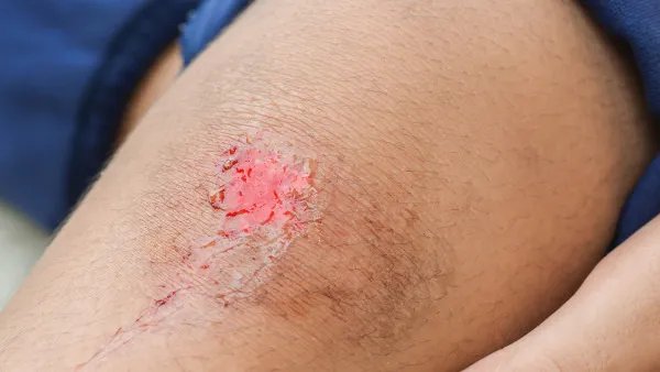 伤口发炎怎么处理