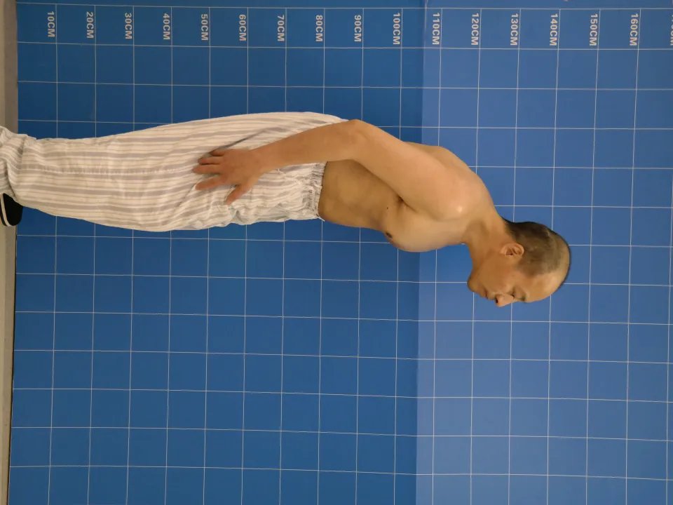 打开折叠人生——极重度脊柱后凸3-ON折叠人手术