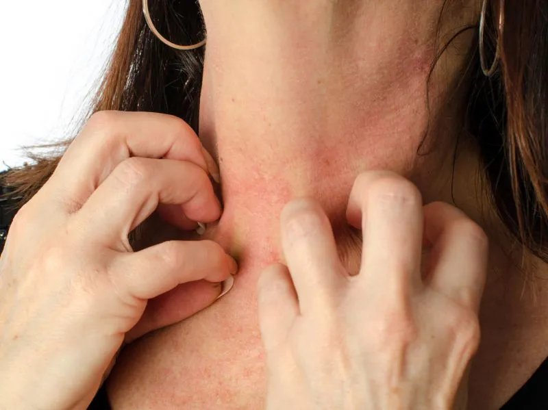 乙酰胆碱性荨麻疹的症状