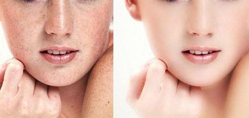 光子嫩肤去斑的价格