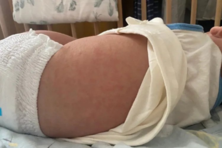 幼儿急疹红斑图片