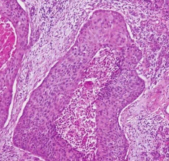 【图】鳞状细胞癌详细图解(唾液腺恶性肿瘤的临床病理)