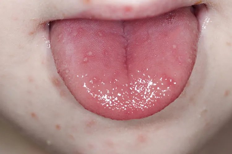 小孩手足口病轻微图片