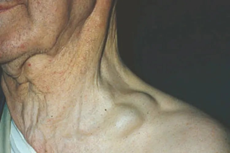 脖子淋巴癌早期图片