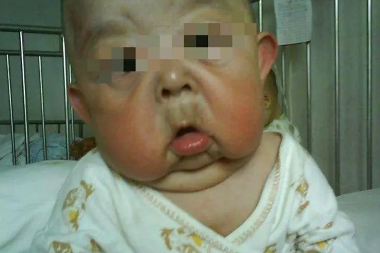 婴儿皮肤松弛症图片