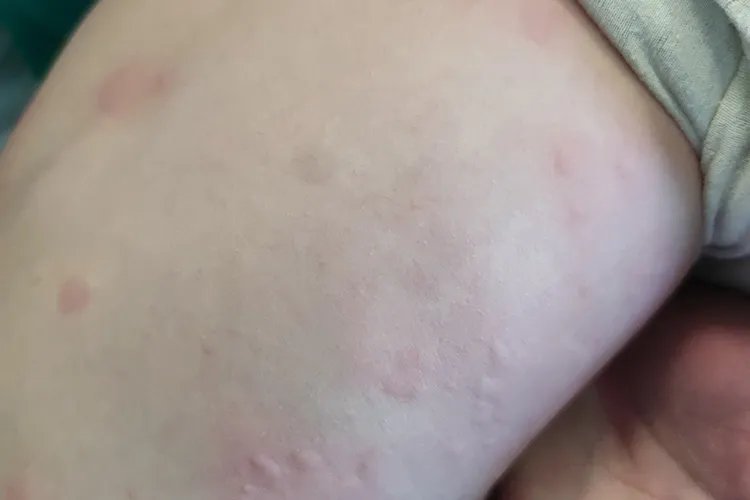 孩子身上起红疙瘩很痒图片