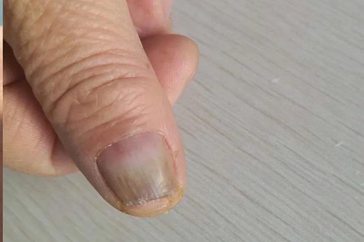 灰指甲图片怎么治疗
