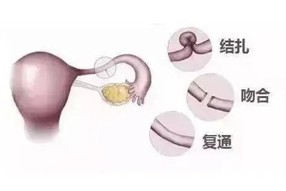 结扎接通手术过程图