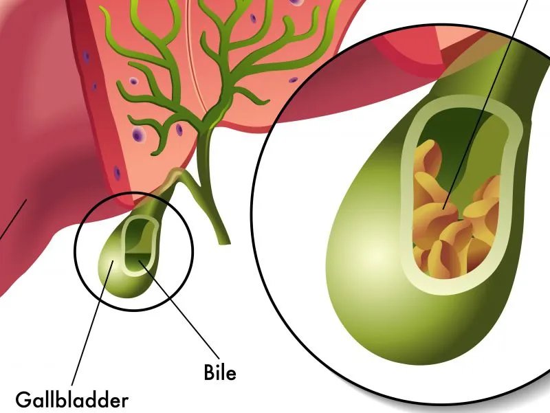 胆囊炎的症状及治疗