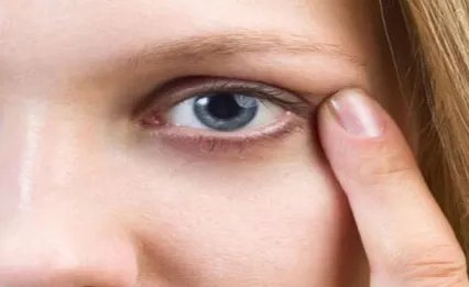 有哪些方法能消除眼部细纹		