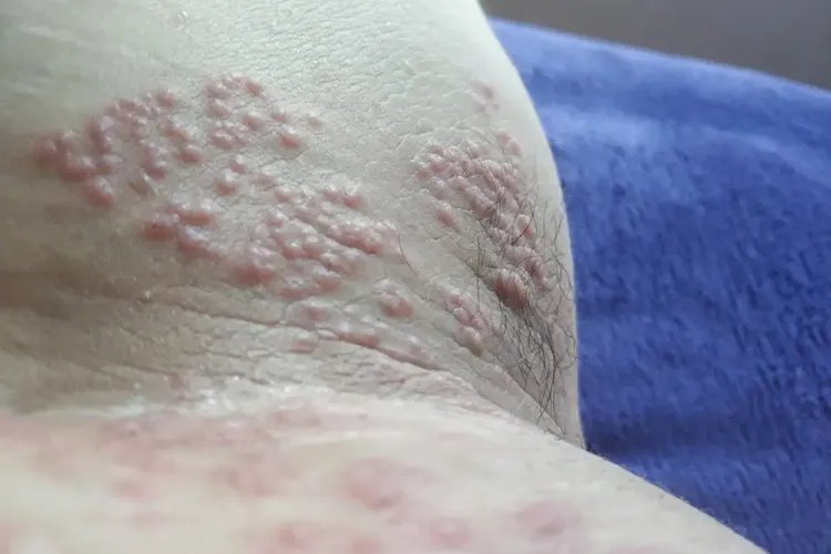 成人红痱子症状图片