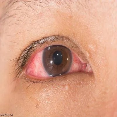 春季卡他性结膜炎吃药管用吗