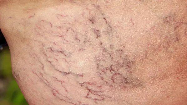 静脉曲张的症状有哪些