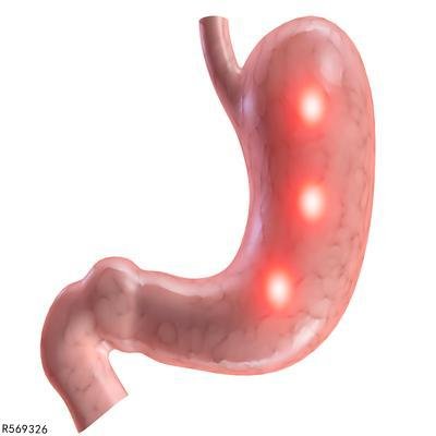 肠胃结石要注意哪些饮食