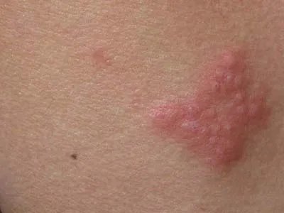 蛇盘疮初期图片