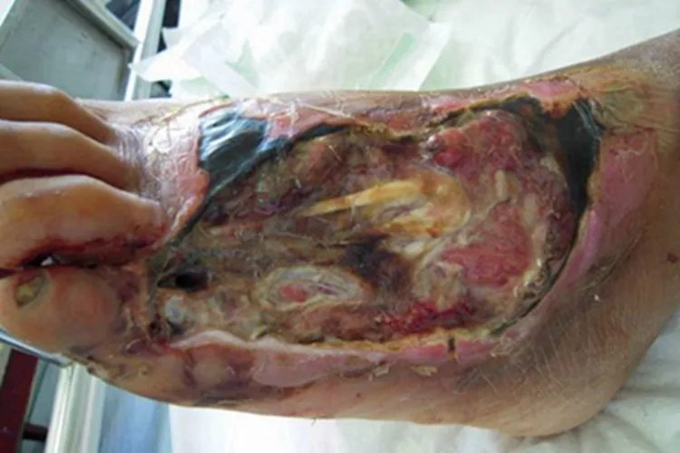 炭疽病脚背症状图片