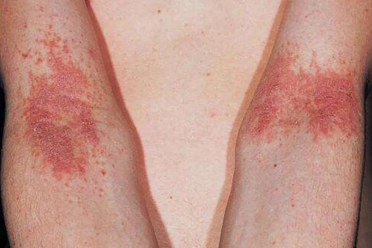 儿童异位性皮炎症状图