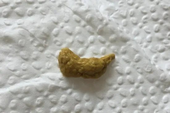 大便颜色9种图解