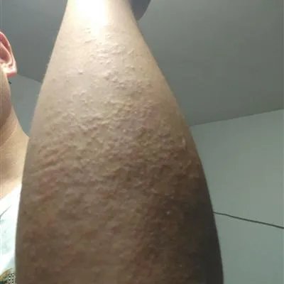 皮下脓肿饮食有哪些注意事项