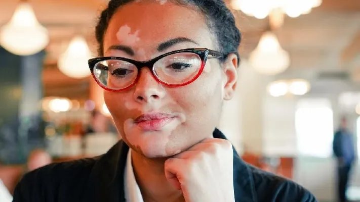 什么是银屑病？