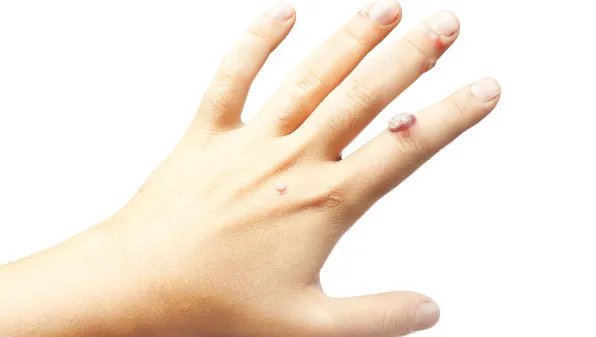 扁平疣治疗方法