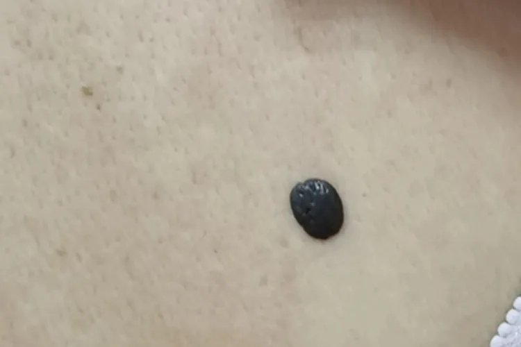 复合痣黑痣图片