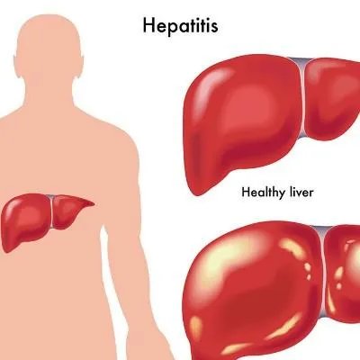 腹水原因有哪些