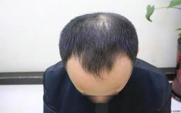 种头发得多少钱