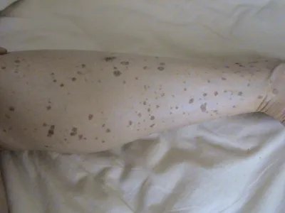 扁平疣样职业性疣赘小腿症状图片