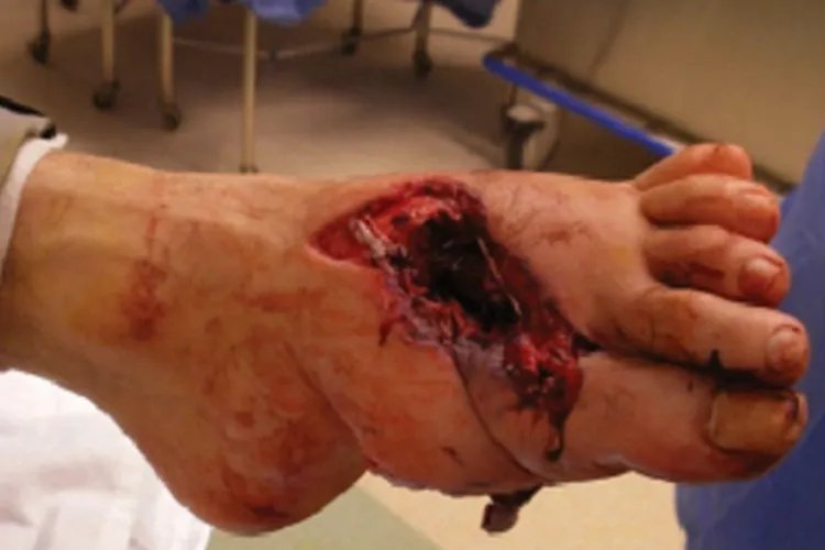 炭疽病脚背症状图片