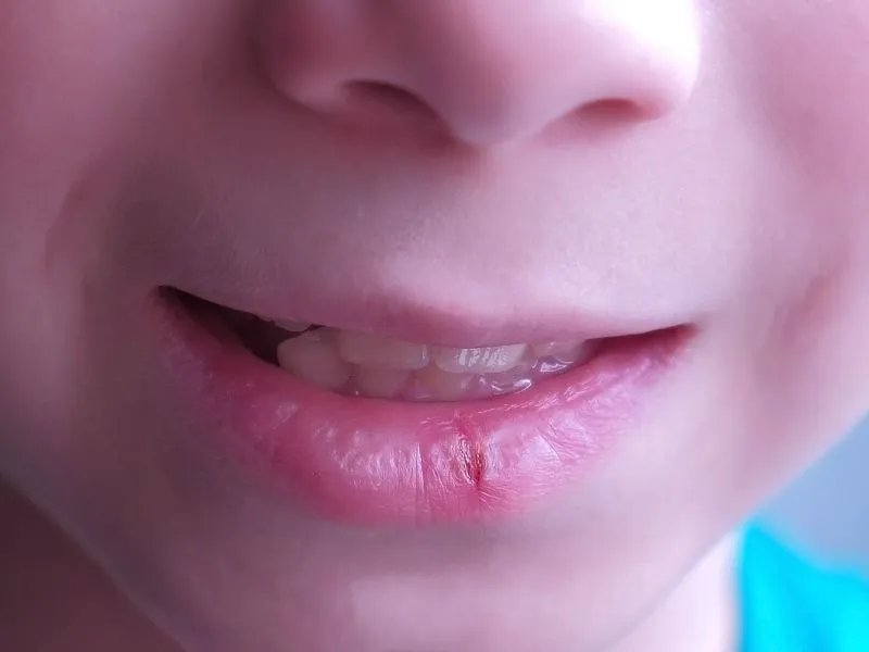 嘴唇干是怎么回事