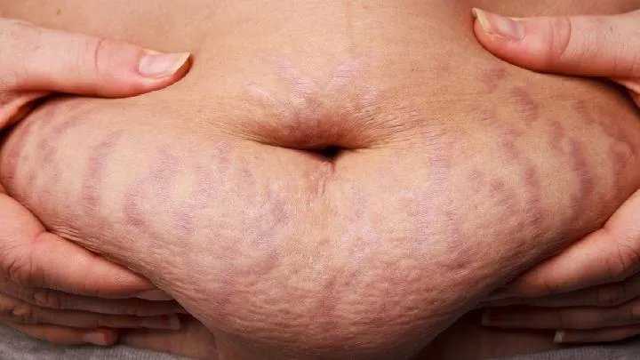 像束激光治疗面部痤疮效果怎么样