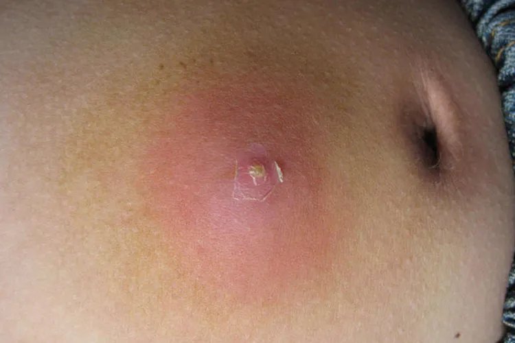 火疖子成熟的图片