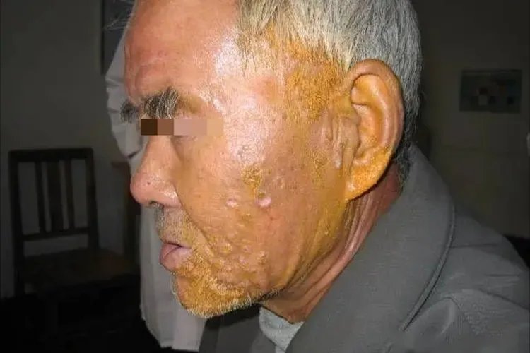 坏疽性脓皮病面部症状图片