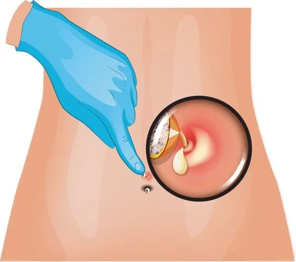 风油精滴肚脐眼的危害